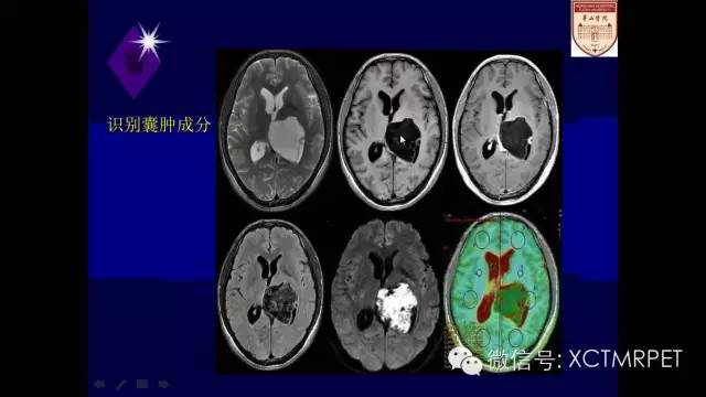 脑肿瘤的MRI