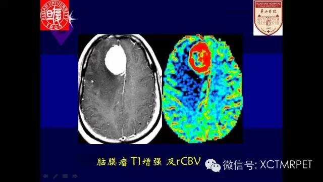脑肿瘤的MRI
