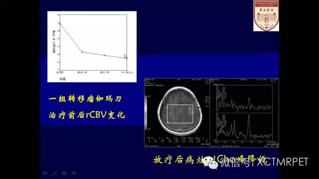 脑肿瘤的MRI