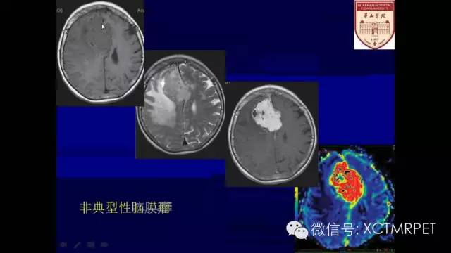 脑肿瘤的MRI