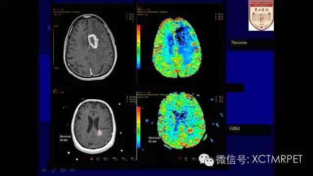 脑肿瘤的MRI