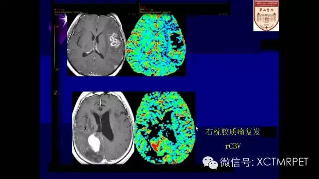脑肿瘤的MRI
