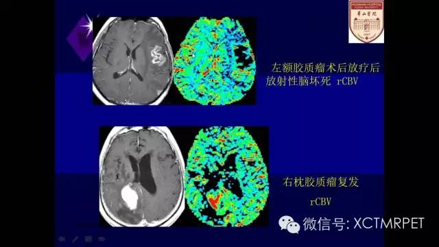 脑肿瘤的MRI