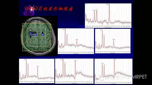 脑肿瘤的MRI