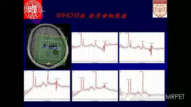 脑肿瘤的MRI