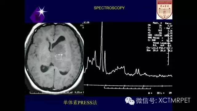 脑肿瘤的MRI