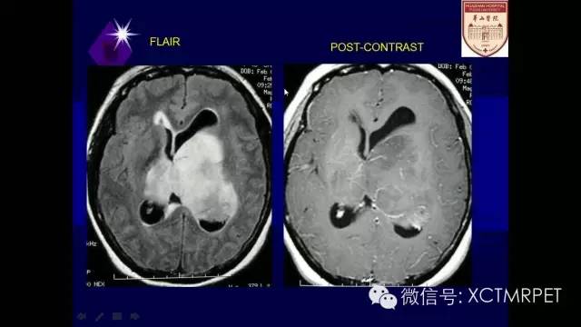 脑肿瘤的MRI