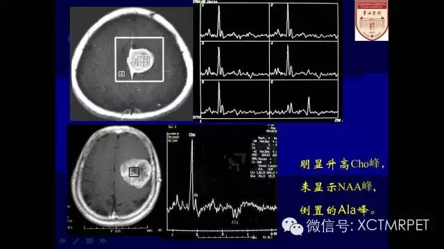 脑肿瘤的MRI