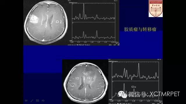 脑肿瘤的MRI