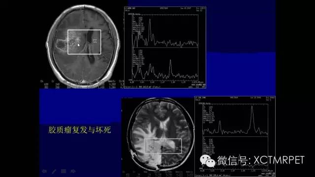 脑肿瘤的MRI