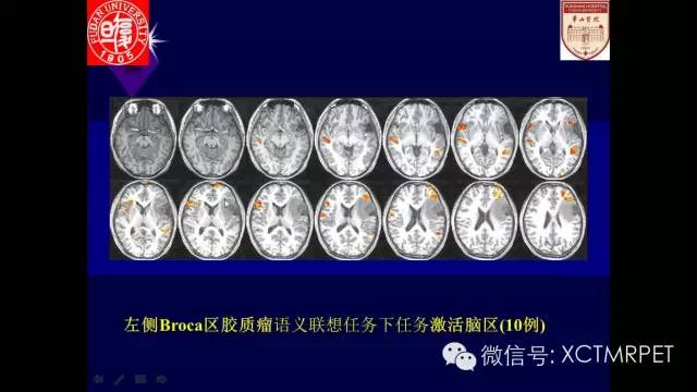 脑肿瘤的MRI