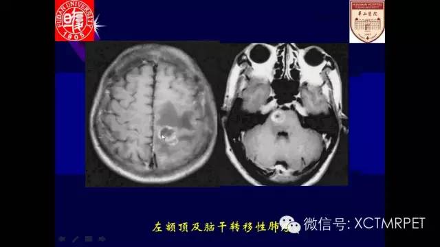 脑肿瘤的MRI