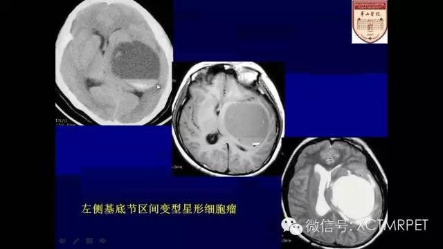 脑肿瘤的MRI