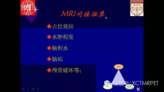 脑肿瘤的MRI