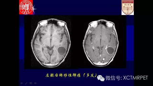 脑肿瘤的MRI