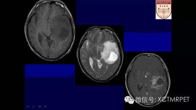 脑肿瘤的MRI