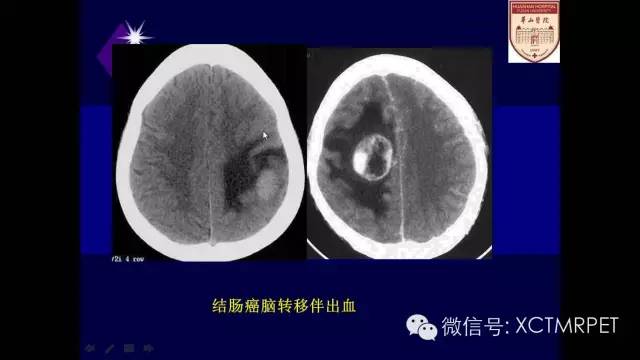 脑肿瘤的MRI