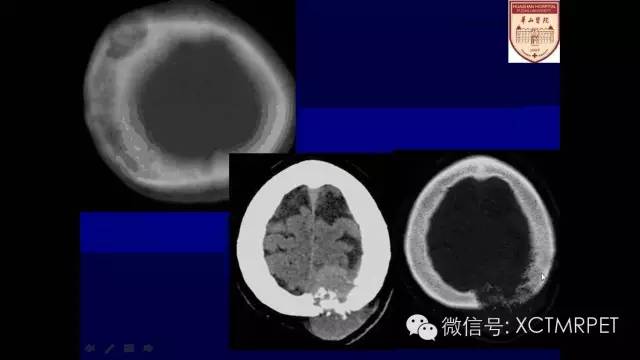 脑肿瘤的MRI