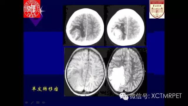 脑肿瘤的MRI