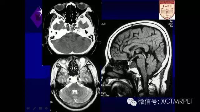 脑肿瘤的MRI