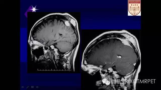 脑肿瘤的MRI