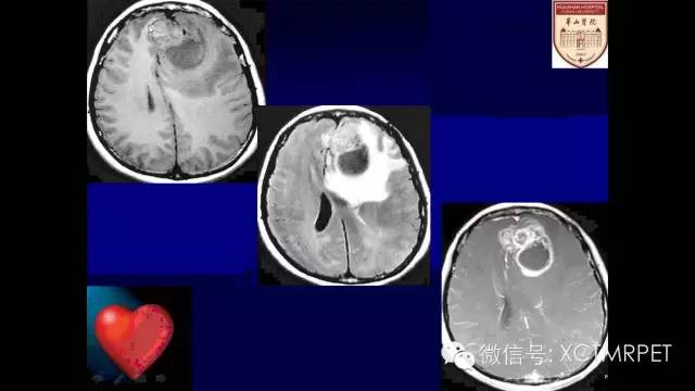 脑肿瘤的MRI