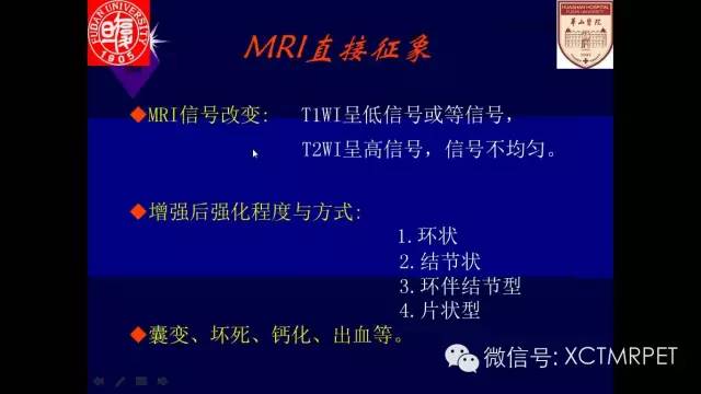 脑肿瘤的MRI