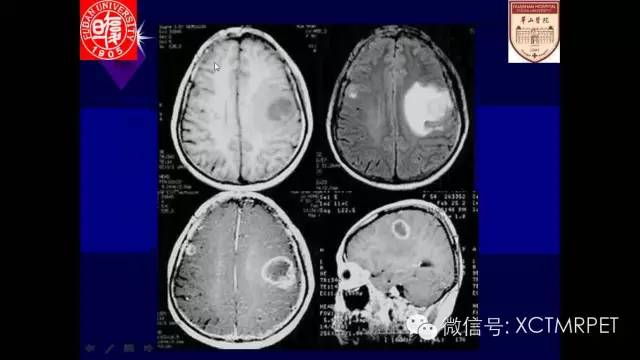 脑肿瘤的MRI