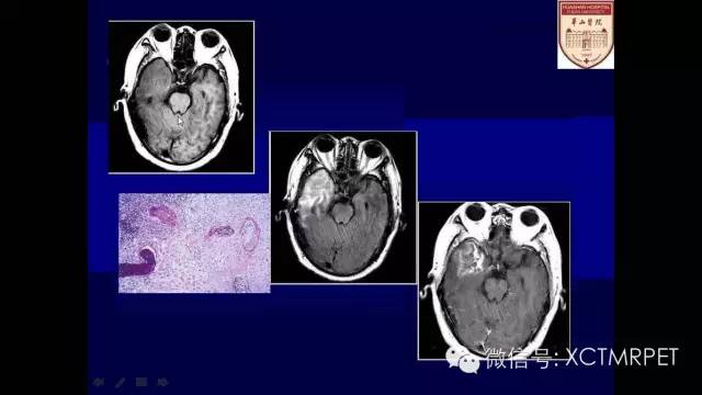 脑肿瘤的MRI