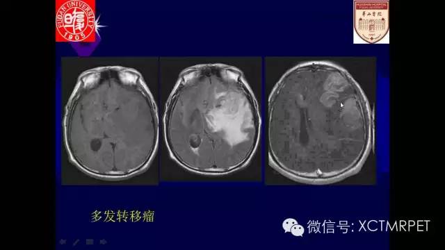 脑肿瘤的MRI