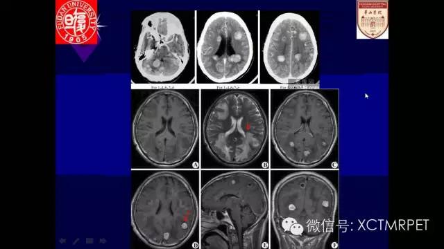 脑肿瘤的MRI