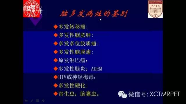 脑肿瘤的MRI