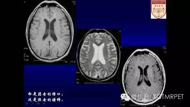脑肿瘤的MRI