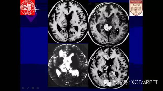 脑肿瘤的MRI