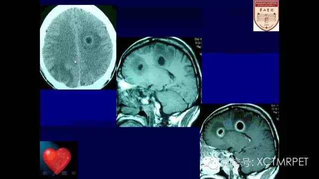 脑肿瘤的MRI