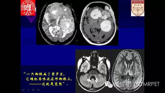 脑肿瘤的MRI