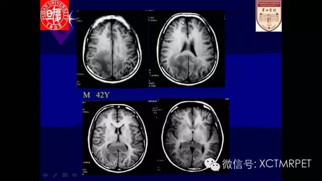 脑肿瘤的MRI