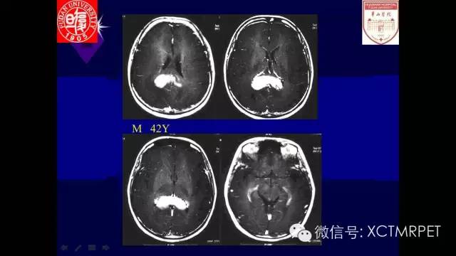 脑肿瘤的MRI