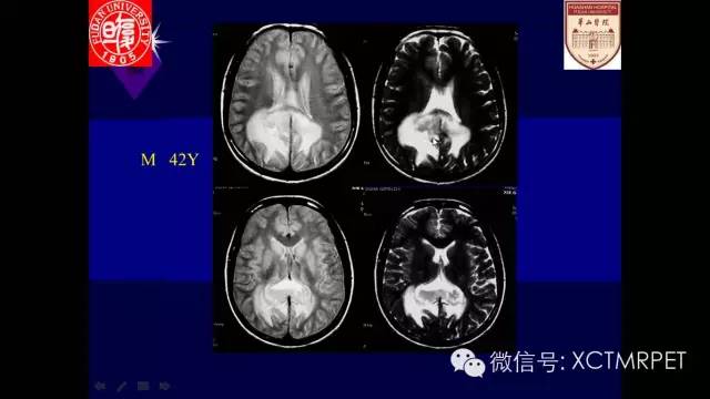 脑肿瘤的MRI