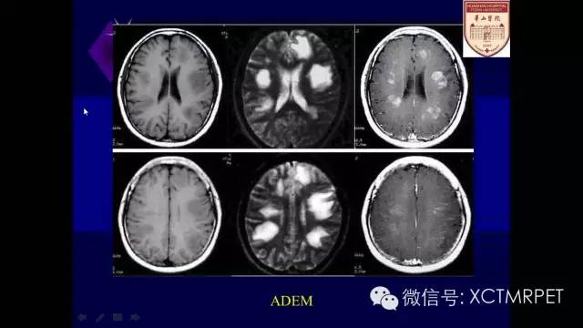 脑肿瘤的MRI