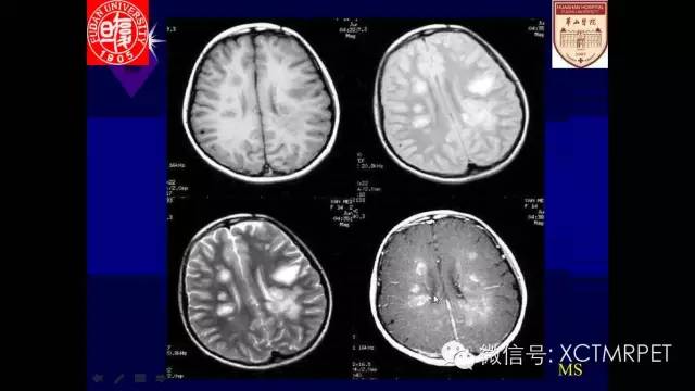 脑肿瘤的MRI