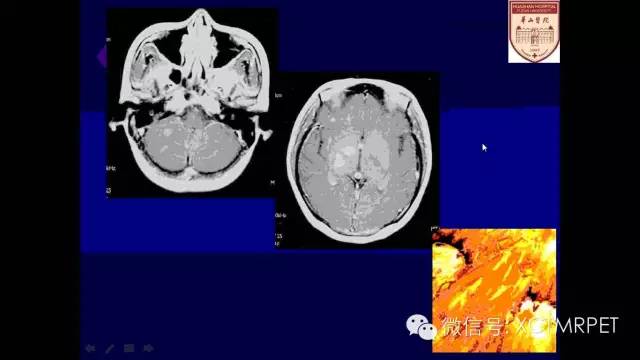 脑肿瘤的MRI