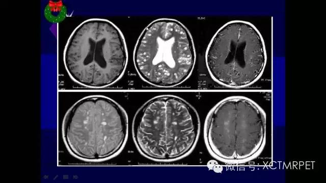 脑肿瘤的MRI