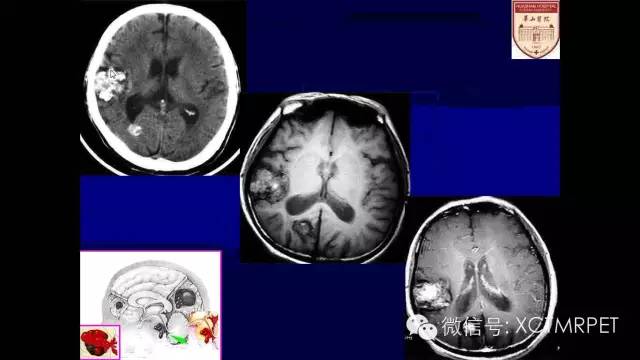脑肿瘤的MRI