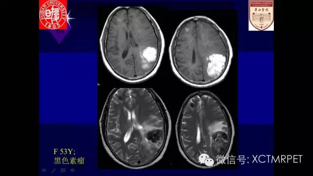 脑肿瘤的MRI