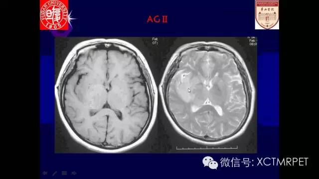脑肿瘤的MRI