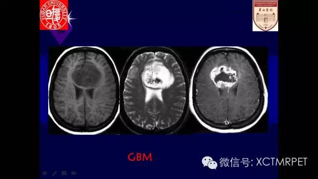 脑肿瘤的MRI