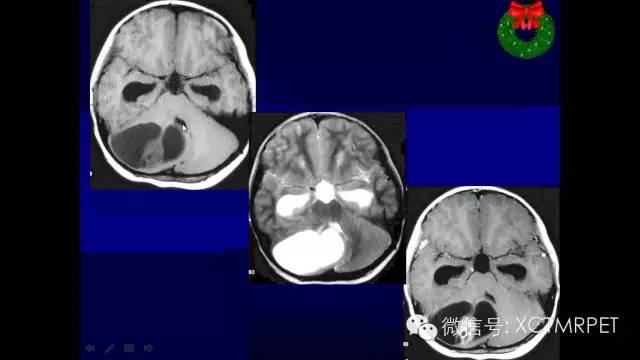 脑肿瘤的MRI