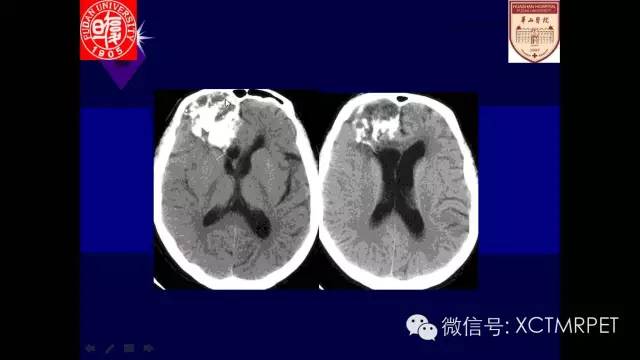 脑肿瘤的MRI