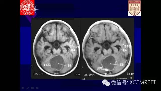 脑肿瘤的MRI